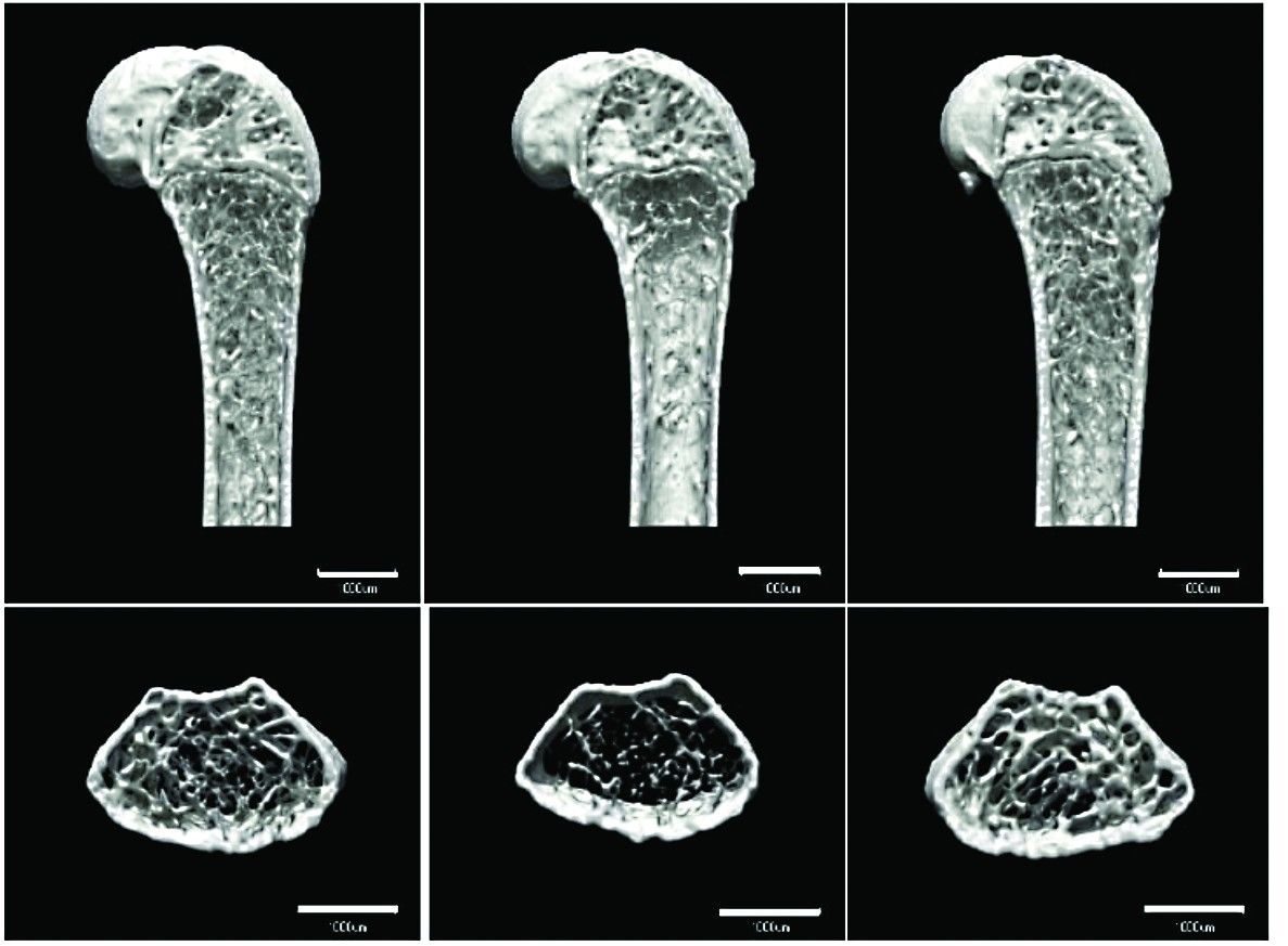 Bone loss due to microgravity