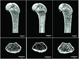 Bone loss due to microgravity