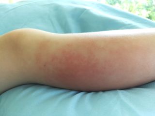 Cellulitis may appear as a light red to dark red or purple rash. The infected skin will swell and feel warm to the touch.