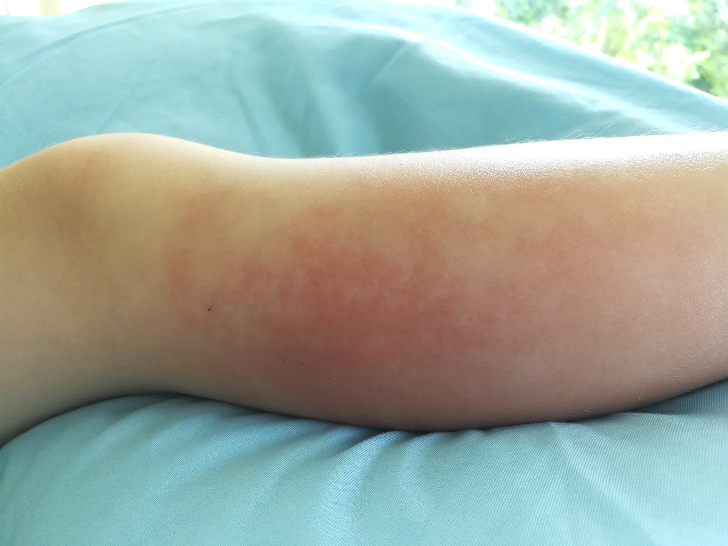 cellulitis warm or cold compress