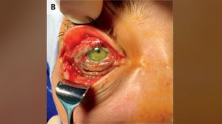 The woman's cowpox infection caused orbital cellulitis, or an infection of the fat and muscles around the eye. She required surgery to remove dead tissue from around her eye.