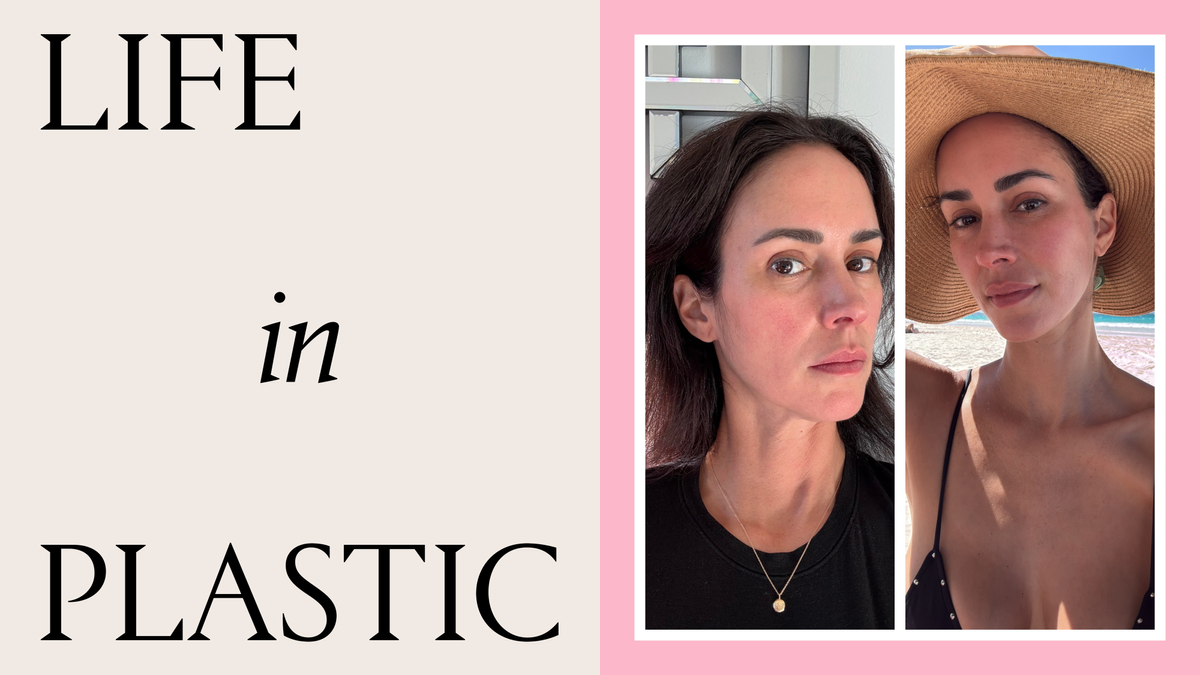 I Got a Facelift at 43 and I Have Zero Regrets