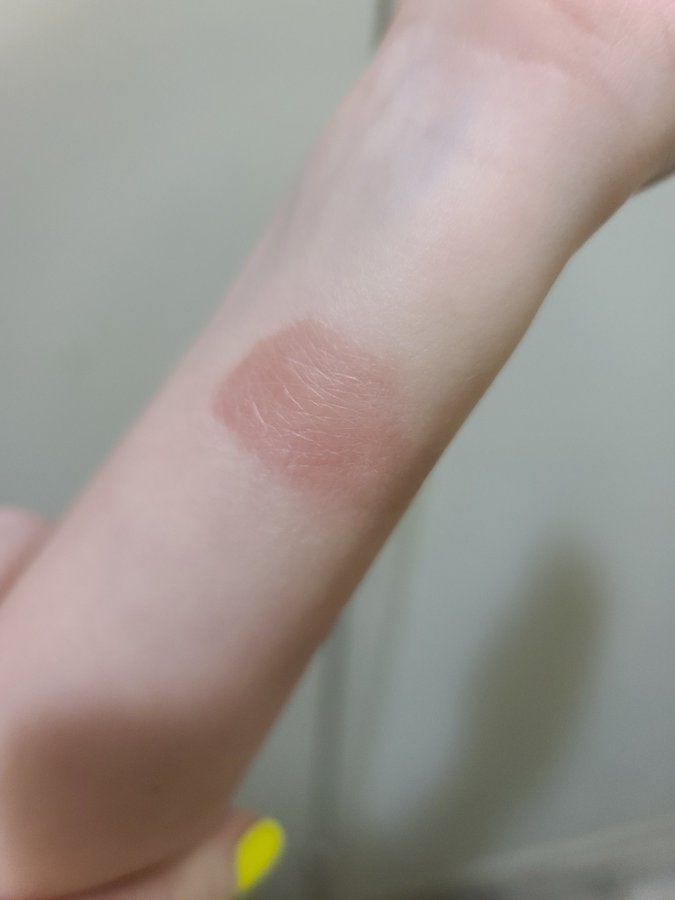 Fitbit burn lawsuit