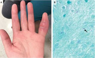 A woman's swollen finger was a rare sign of tuberculosis infection. Above, an image of the woman's finger (panel A), and a microscopic view of the infection (panel B). An arrow points to the tuberculosis bacteria.