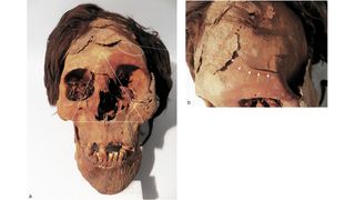 The partially mummified remains of a male who had lethal trauma on his face and skull.