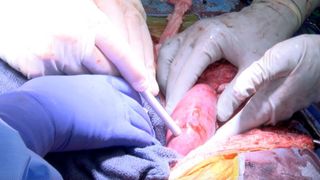 photo shows gloved hands placing a pig kidney into a human recipient