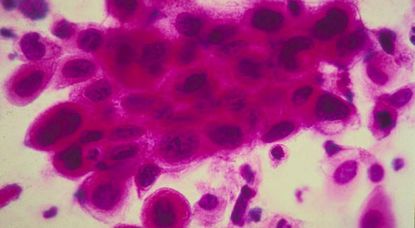 141112-cancer-cells.jpg