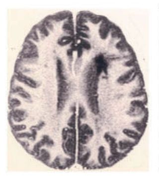 An MRI scan of the brain. The darker area shows a brain lesion in the left hemisphere.