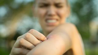 A woman with a bite or sting on her arm