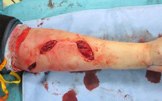 Surgeons performed a fasciotomy on a patient's arm to prevent tissue death from the extreme pressure.