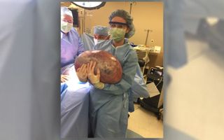 Doctors removed a 50-pound ovarian tumor from a woman in Alabama.