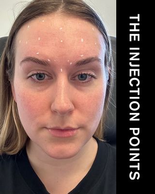 Beauty editor Kaitlyn McLintock with Botox injection points