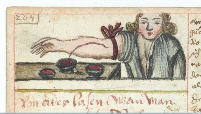 Ancient bloodletting illustration