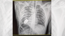 An X-ray image of the unexploded grenade, lodged just below the soldier's heart. 