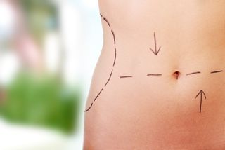 A woman's tummy is marked up with lines for surgery