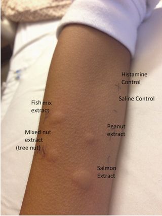 A skin-prick test given to the 8-year-old child showing that he has acquired reactions to peanut, tree nut mix, fish mix and salmon.