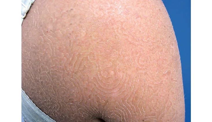 Fungal Infection Causes Swirling, 'Maze-Like' Rash