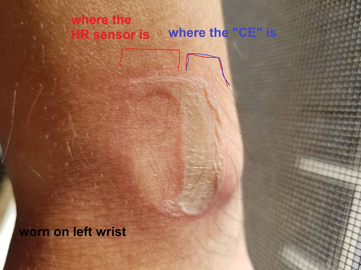 Fitbit burn lawsuit