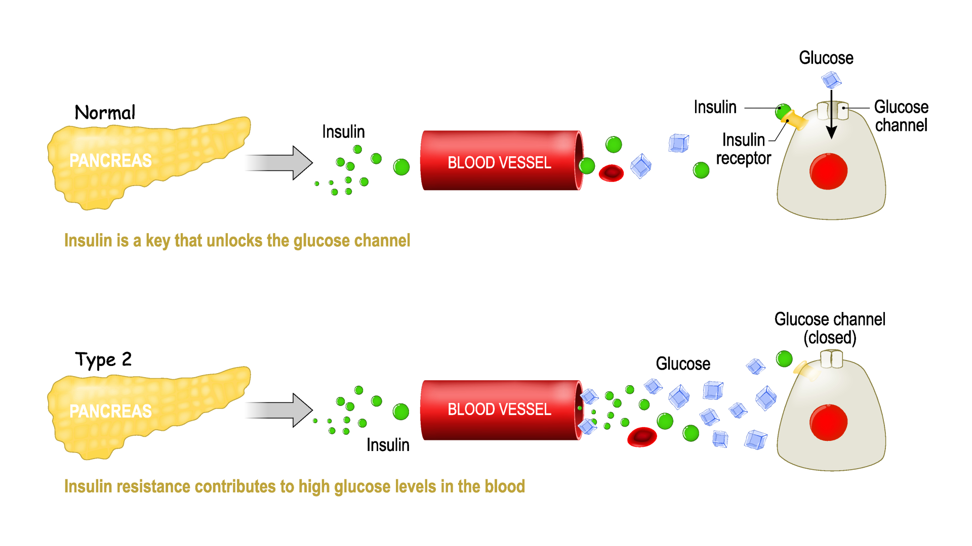 Type 2 diabetes diagram - Comparison of cell work in diabetes and in a healthy body. Designua via Shutterstock