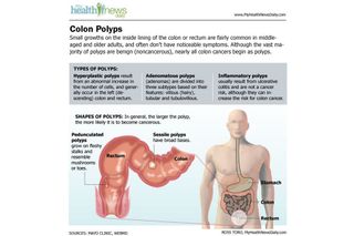 Anal Polyp - Colon Cancer: Causes, Symptoms and Treatments | Live Science