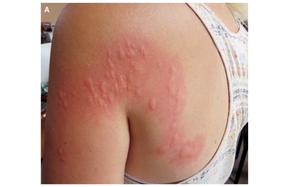 Adult Nappy Rash / Incontinence Associated Dermatitis – Novamed (Europe) ltd