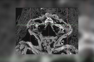 The micro-CT scan, conducted at Nikon Metrology, shows that the mummy suffers from anencephaly, a rare disease in which part of the brain and skull fails to develop.