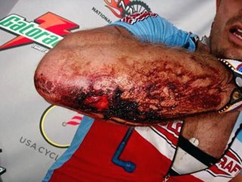 Yuri Hauswald's arm