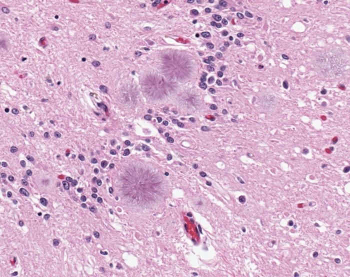 Brain with Creutzfeldt jakob disease