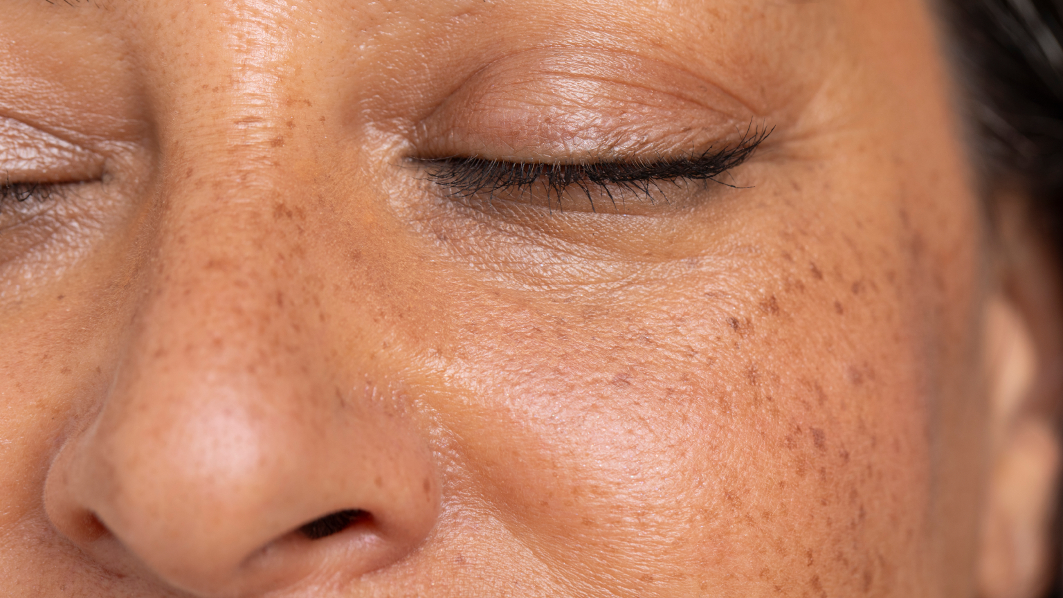melasma dark spots