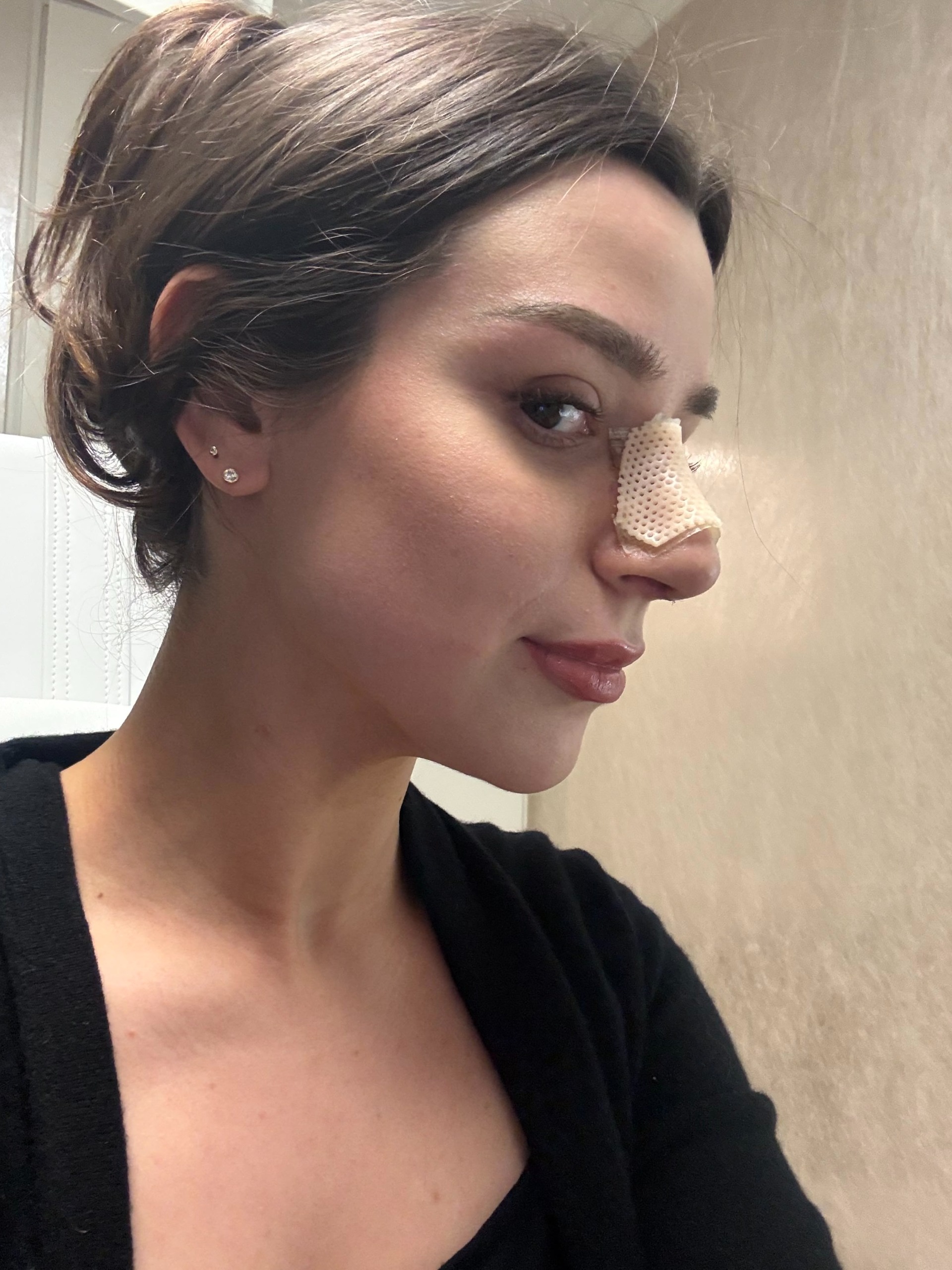 a girl post nose job with a cast on