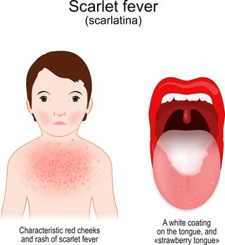 An illustration showing some of the most common symptoms of scarlet fever