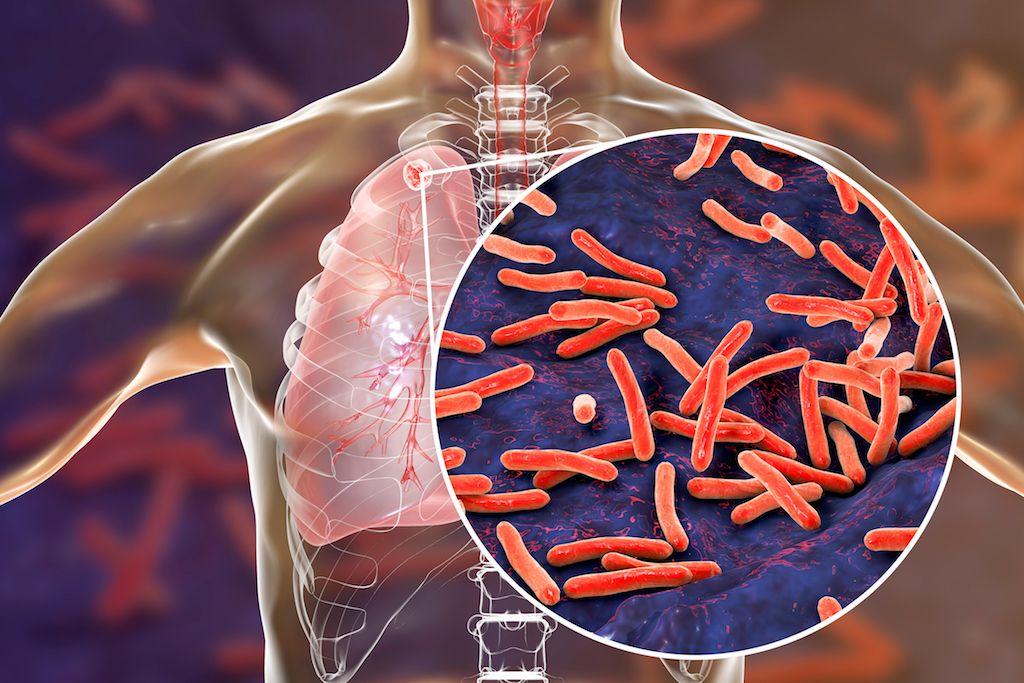 Tuberculosis: Symptoms, Treatment & Prevention | Live Science