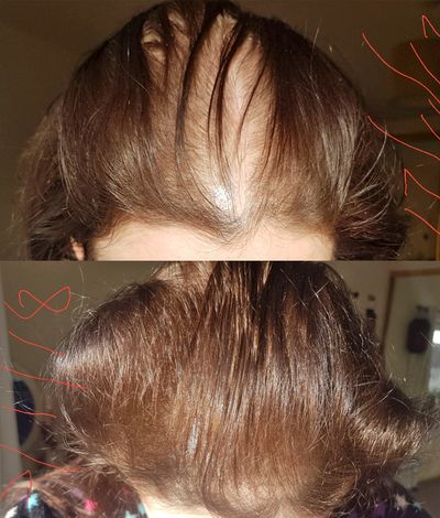 How Rogaine Regrew This Woman's Thinning Hair In 6 Weeks - Rogaine ...