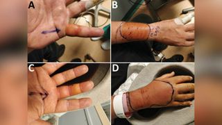 grid of four photos showing signs of redness and swelling from infection in a man's A) left little finger, B) right forearm, C) right middle finger, and D) top of his right hand.
