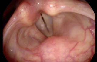 Human vocal folds