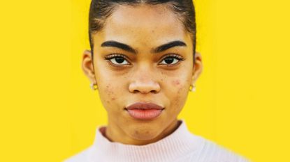 Portrait of a Young latin girl with acne posing in front of a yellow background