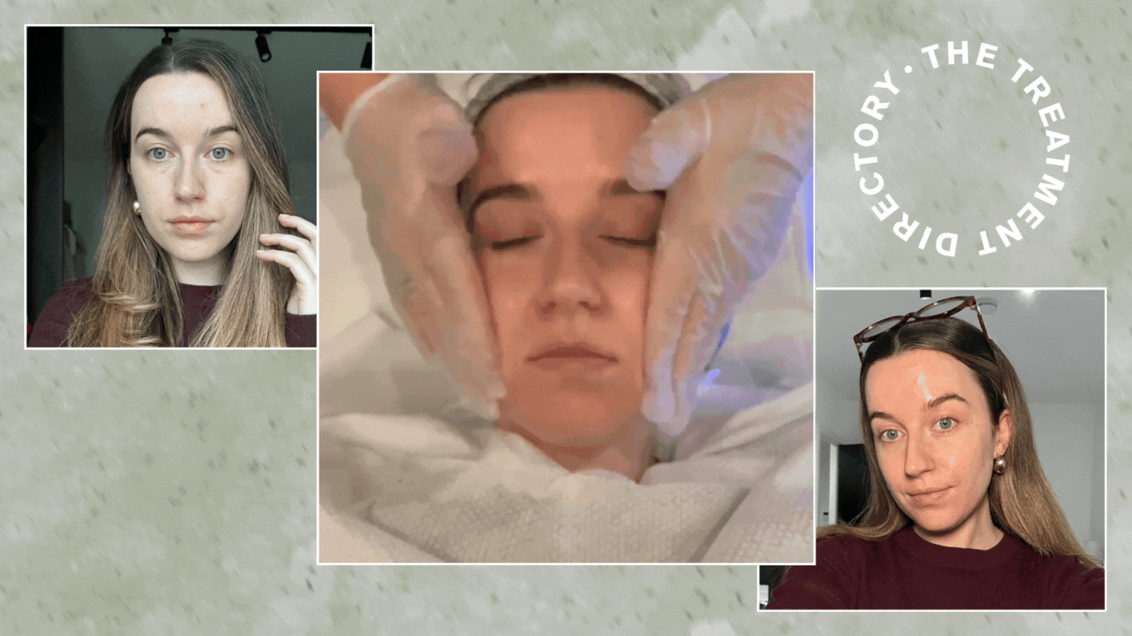 Junior beauty editor Grace Lindsay getting a Hydrafacial