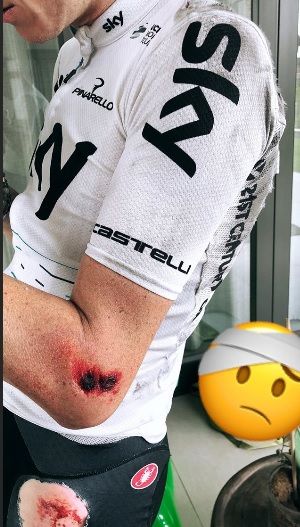 Chris Froome posted a picture of his crash injuries on Instagram