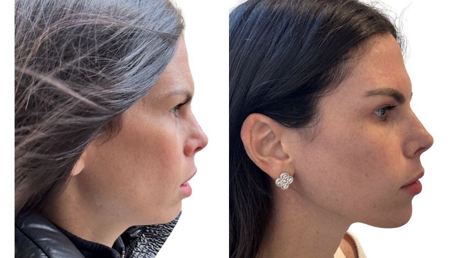 before and after facetite, a woman's chin and jaw profile