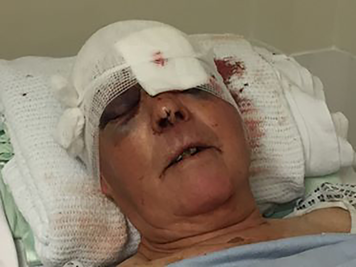 head-injury
