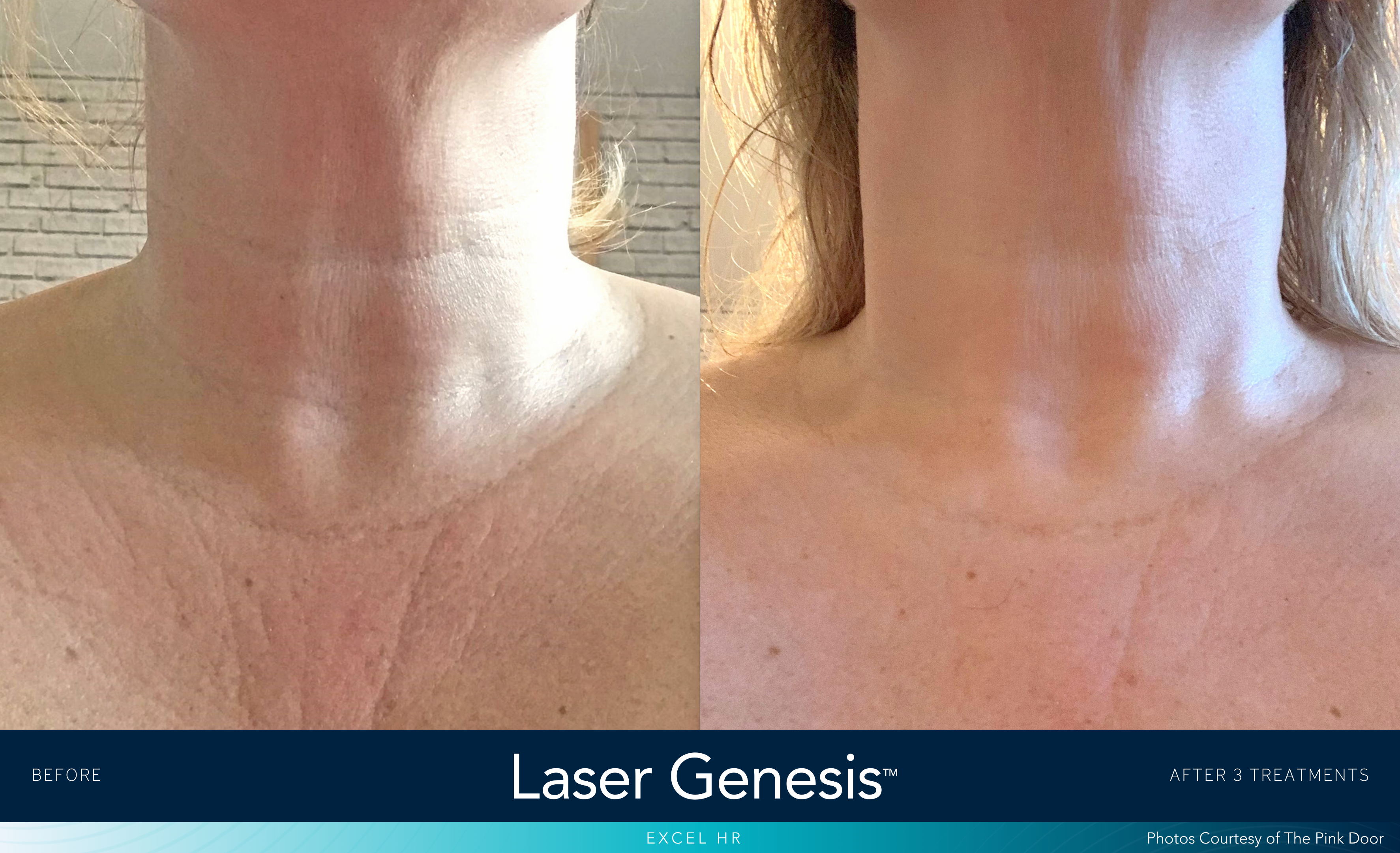 a before and after image of a woman&#039;s neck