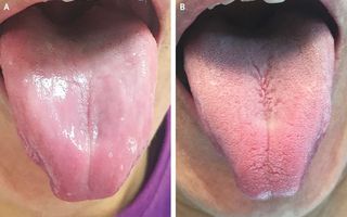 A man's tongue was missing "papillae," or the small bumps on the tongue that often contain taste buds (A). After treatment, the man's tongue returned to normal (B).