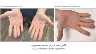 A figure from the case report showing two side-by-side images of the man's hands with the yellow bumps on show. 