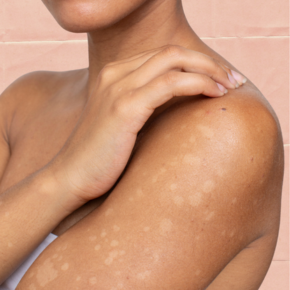 hypopigmentation