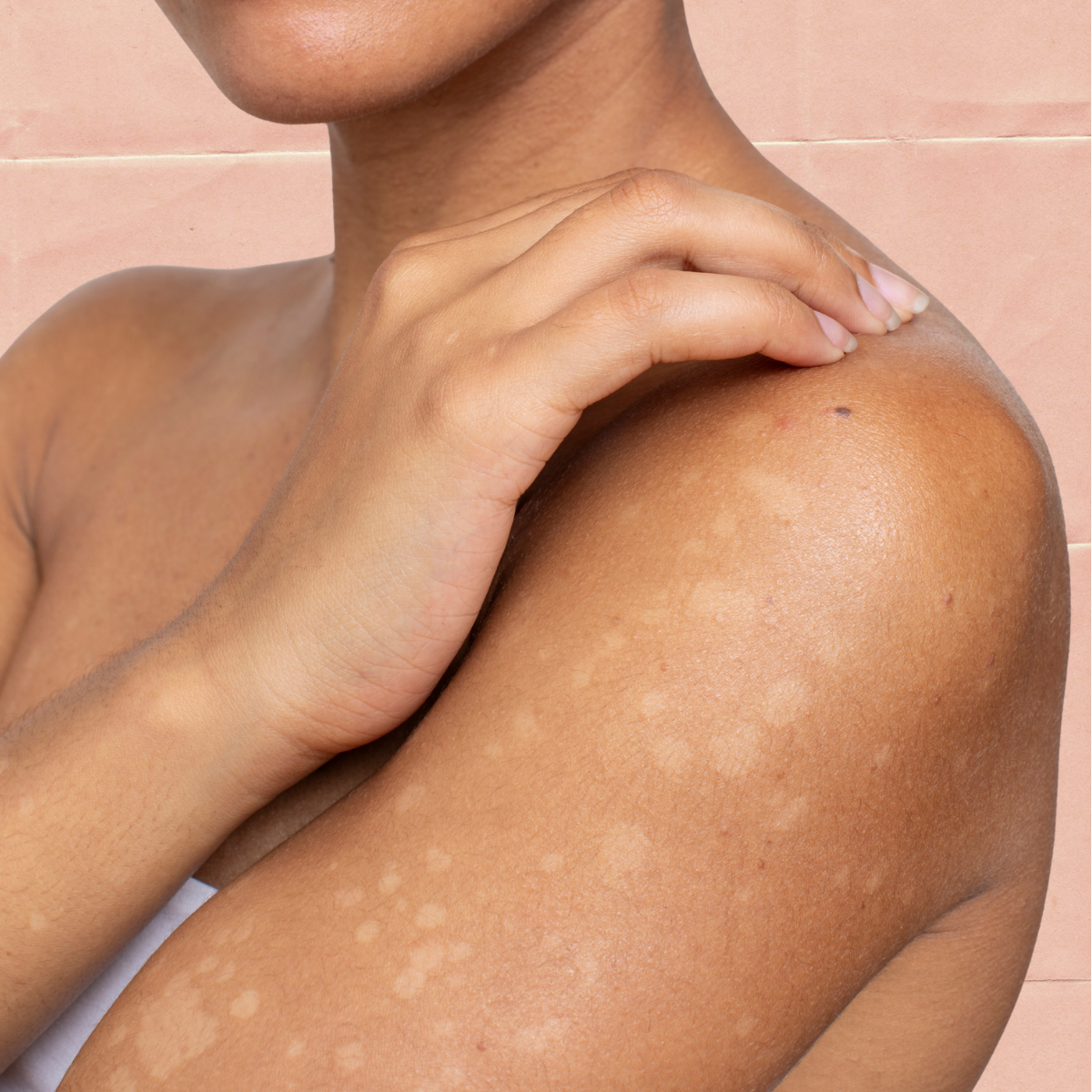 hypopigmentation