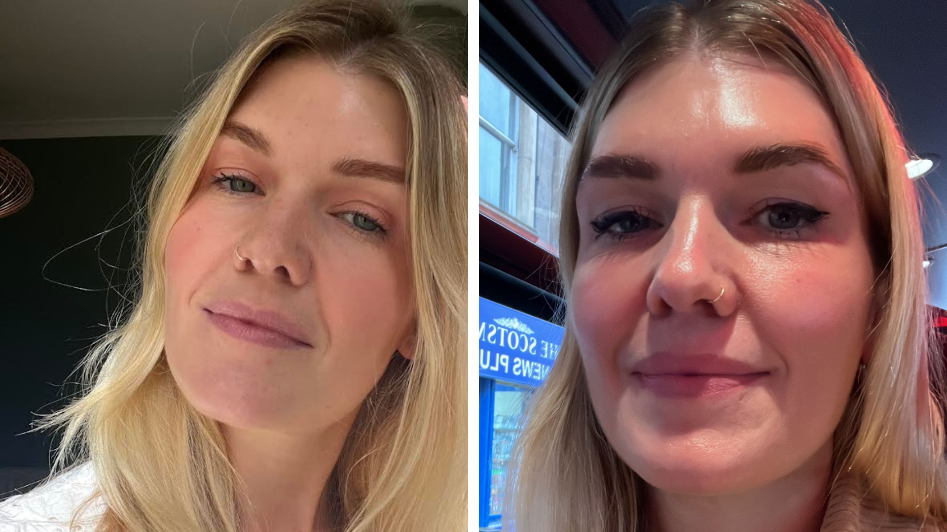 Two pictures of Fiona Mckim with blonde hair and a smooth forehead after trying botox injections