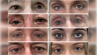 Grid of images of the eyes of eight patients who received a prosthetic eye in the new study