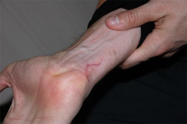 The marks of the bizarre injury he suffered last July in Denmark. His hand went through a plane of glass, suffering deep cuts and nerve damage.