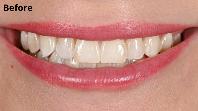 A photo of Siena&#039;s teeth before veneers.