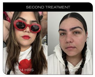 Before and after photos of woman getting lip filler dissolver
